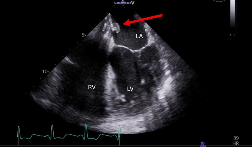 Late Infective Endocarditis Involving a Gore HELEX® Atrial Septal Occluder Presenting as a Multiple Sclerosis Pseudo-Flare: A Case Report
