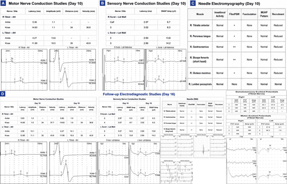 Electrodiagnostic-studies-demonstrating-tibial-division-dominant-sciatic-neuropathy.