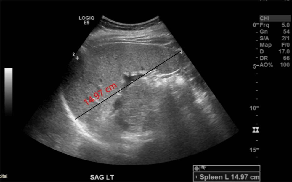 Hereditary Elliptocytosis Presenting with Splenomegaly: A Case Report