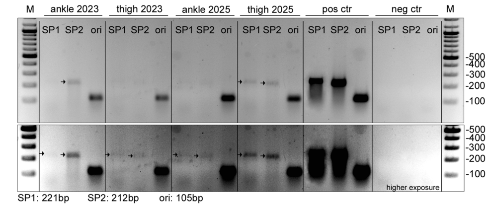 IVIG Restores Nerve Fiber Density in Post-Vaccine Small Fiber Neuropathy