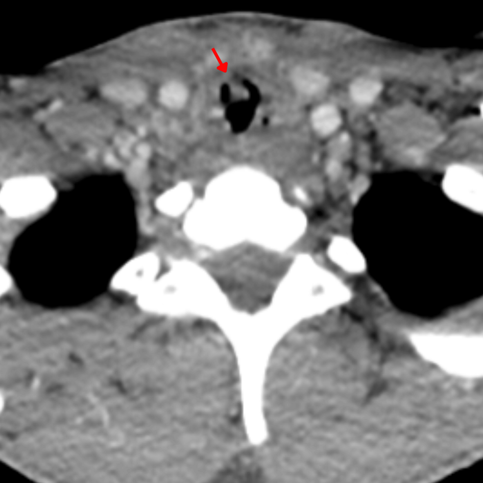 Tracheal Actinomycosis Presenting as a Pseudotumor: A Case Report
