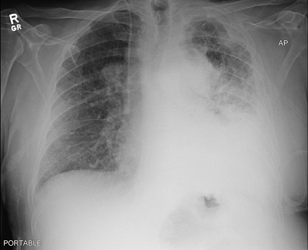 Cureus | Pulmonary Large Cell Neuroendocrine Carcinoma: A Rare Type of ...