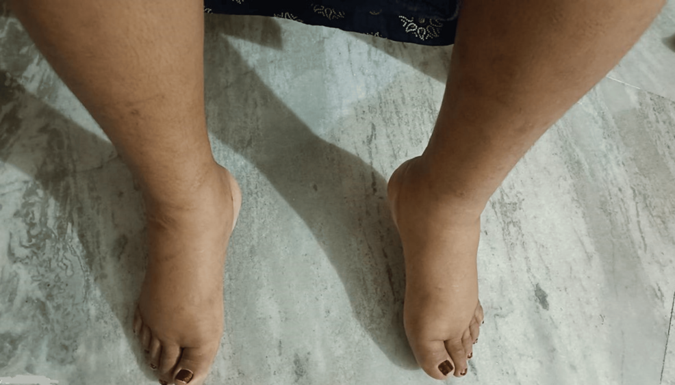 Eisenmenger Syndrome in Pregnancy: A Challenging Case With Important Implications for Primary Care and Maternal Mortality Reduction
