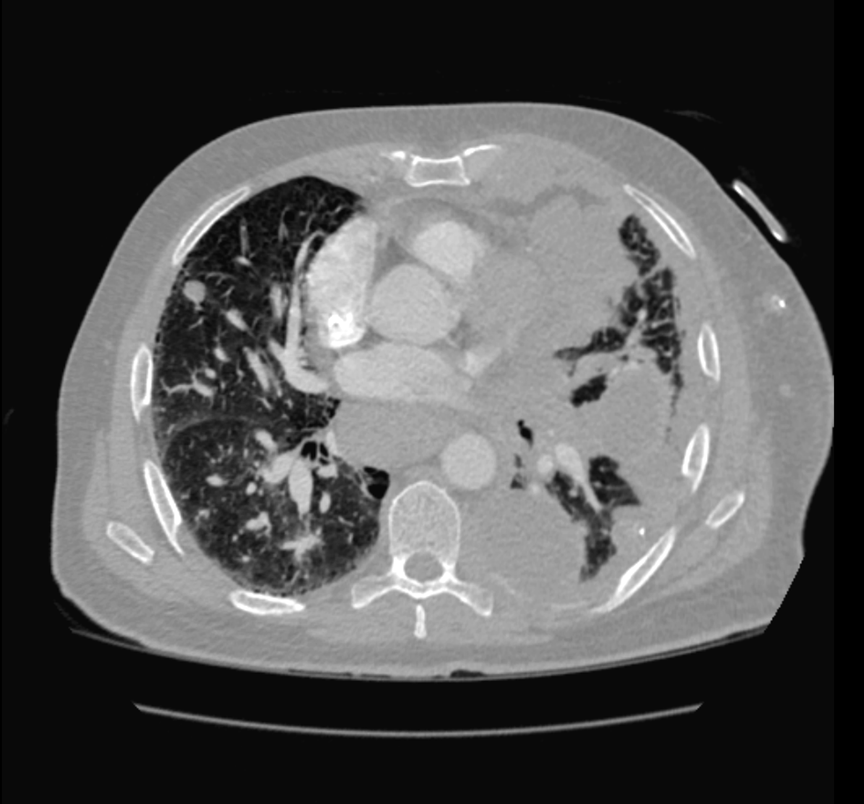 Pulmonary Large Cell Neuroendocrine Carcinoma A Rare Type Of Non Small Cell Lung Cancer Cureus