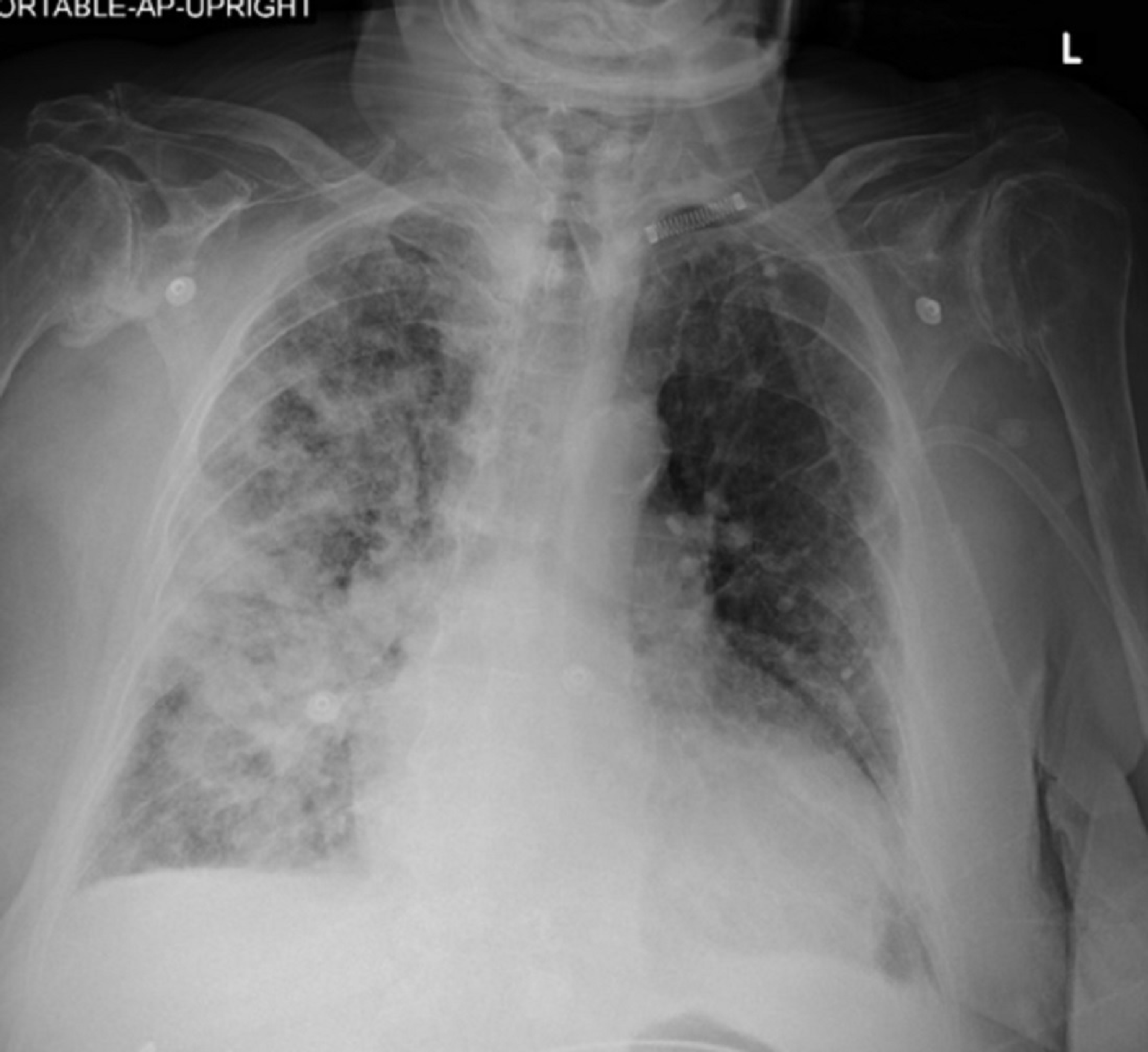 Cureus Unilateral Diffuse Alveolar Hemorrhage Due To Selective