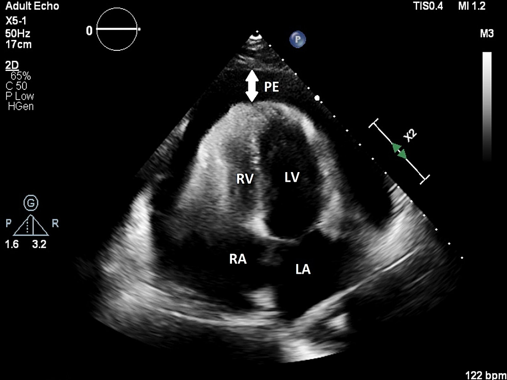 Transthoracic-echocardiogram-(apical-view)-revealing-pericardial-effusion