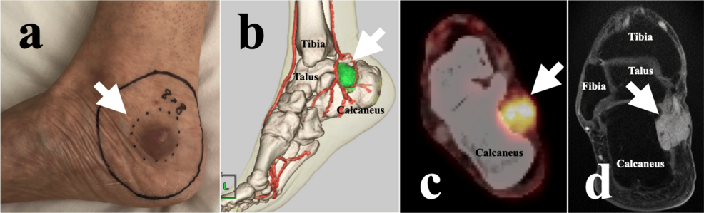 SBRT for Metastatic Clear Cell Sarcoma: A Palliative Case Report