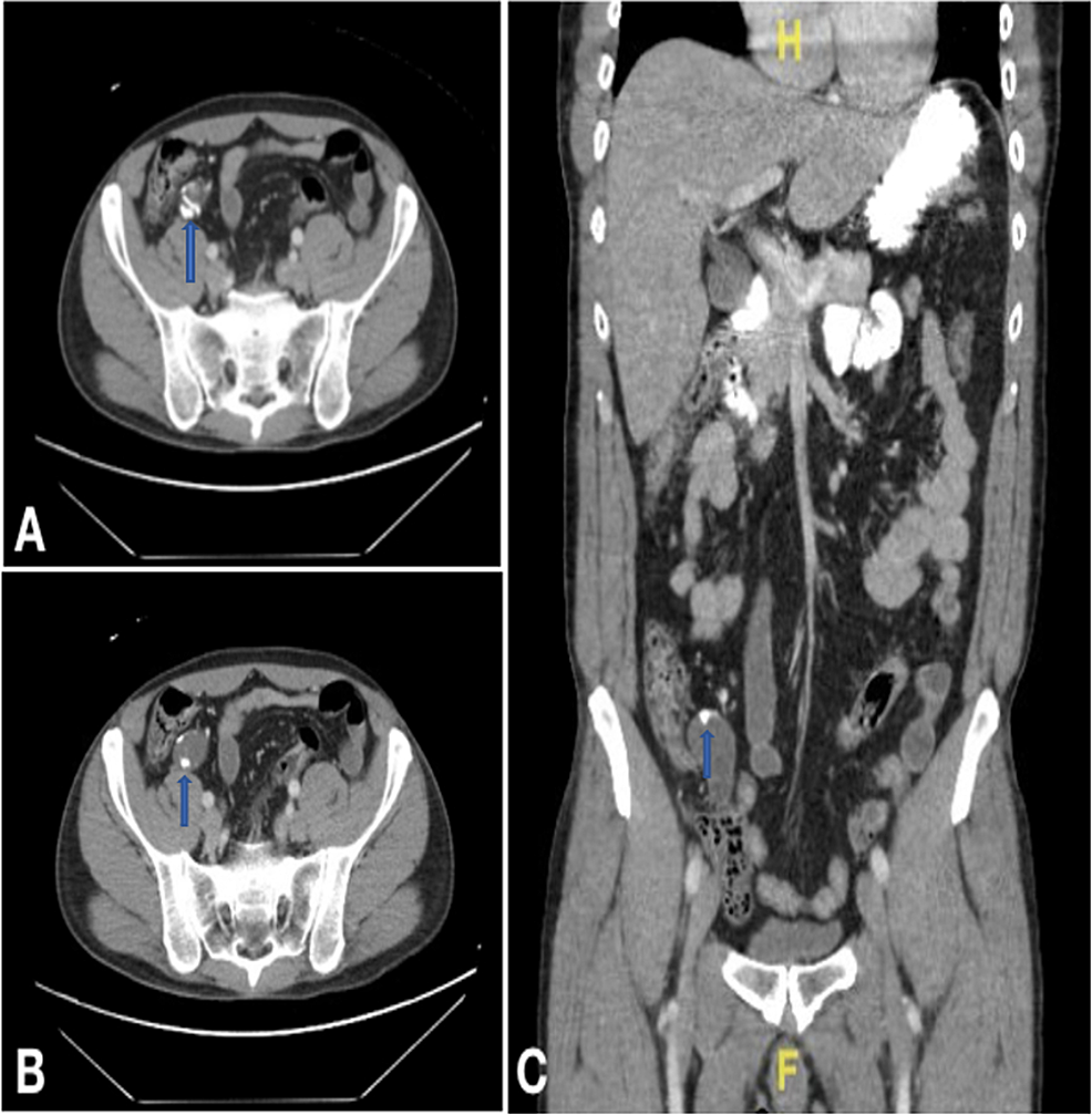 Cureus | The Appendix: A Rare Case of an Appendiceal Collision Tumor