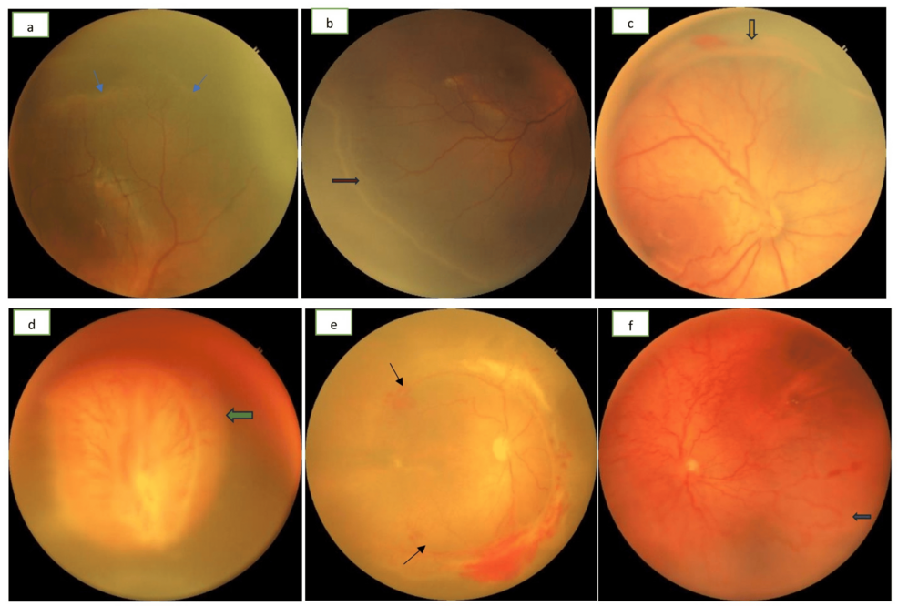 Prevalence and Risk Factors of Retinopathy of Prematurity Among the Infants Screened at a Tertiary Level Hospital in Central India: A Cross-Sectional Study