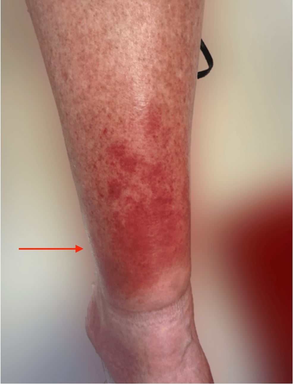 cigarette rash What Does A Vape Look Like? Recurrent Lower-Extremity Purpura Mistaken for