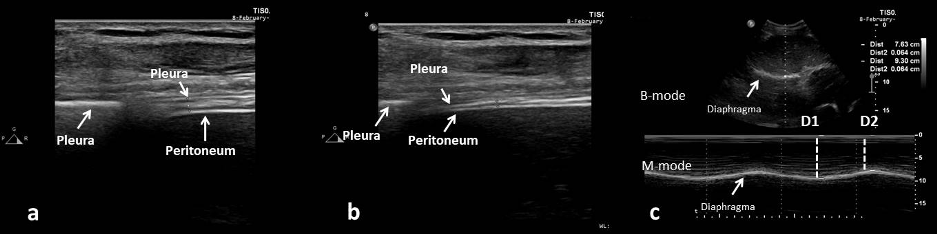 Cureus | Diaphragm And Lung Ultrasonography During Weaning From ...