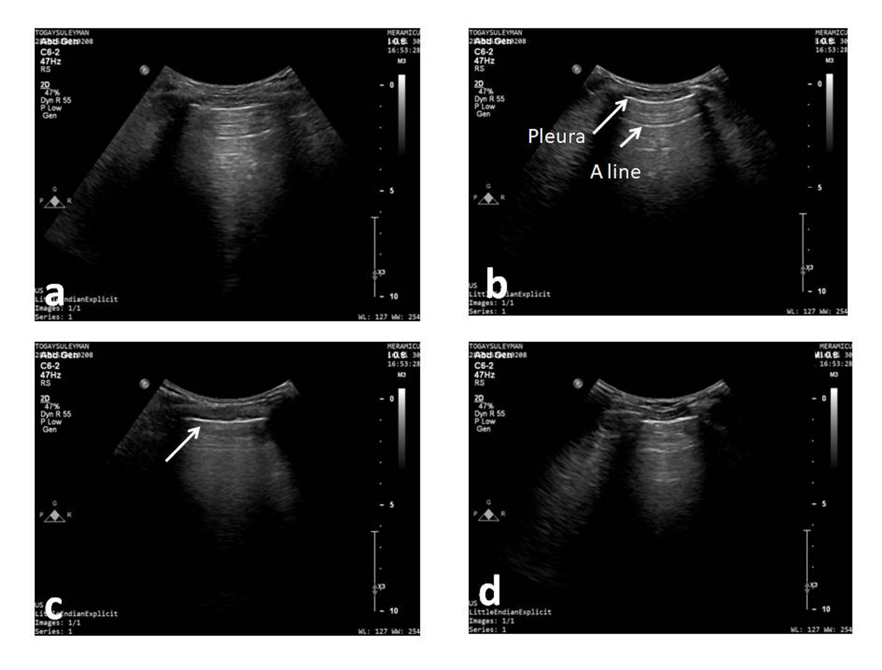 Cureus Diaphragm and Lung Ultrasonography During Weaning From
