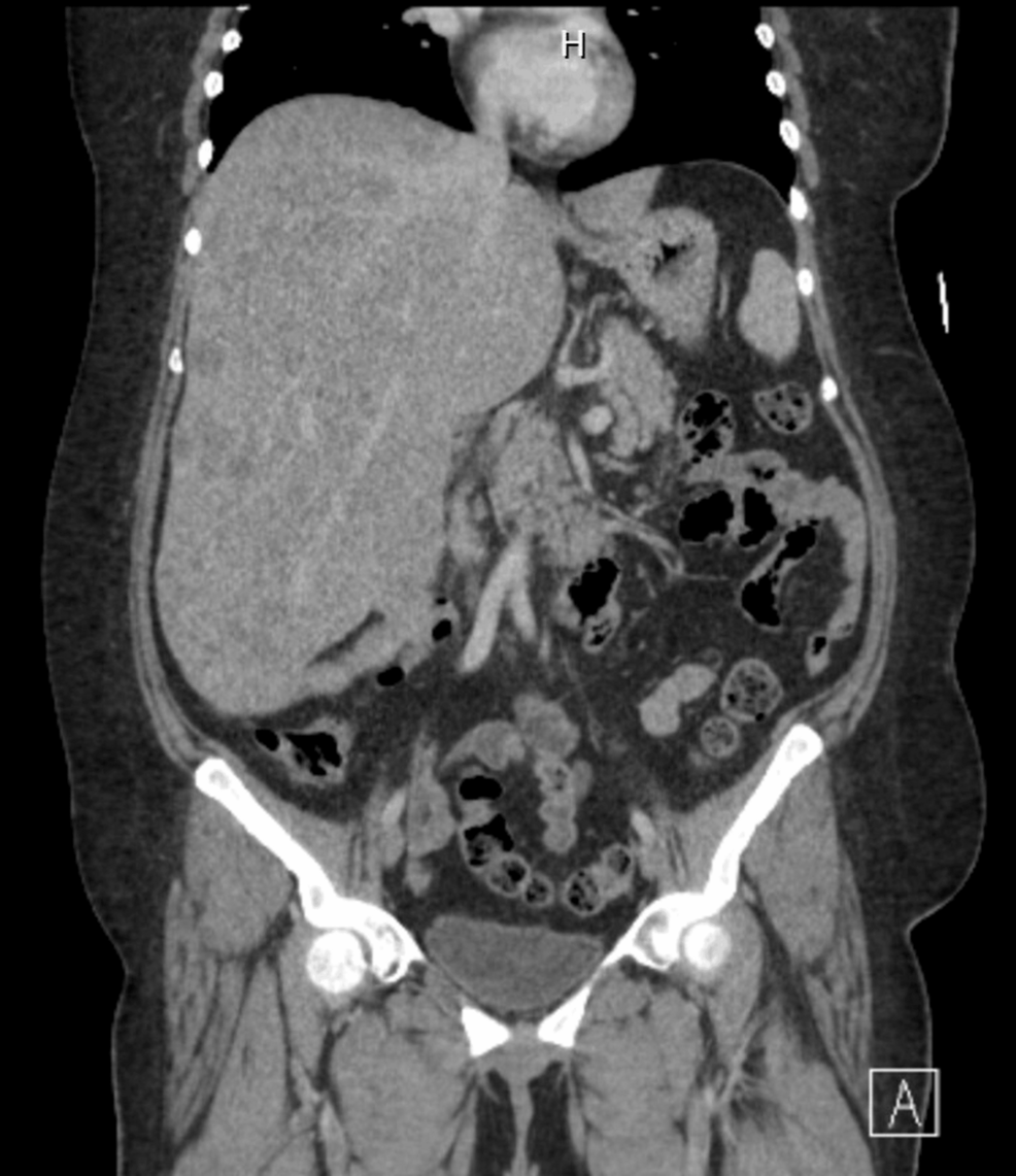 Urgent Chemotherapy for Aggressive Metastatic Neuroendocrine Cancer With Impending Hepatic Failure: A Case Report