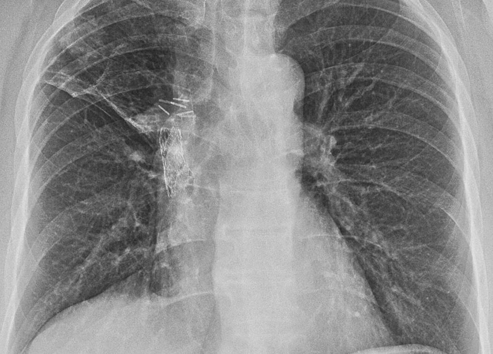 Cureus A Case of Localized Pulmonary Calcification Presenting as a
