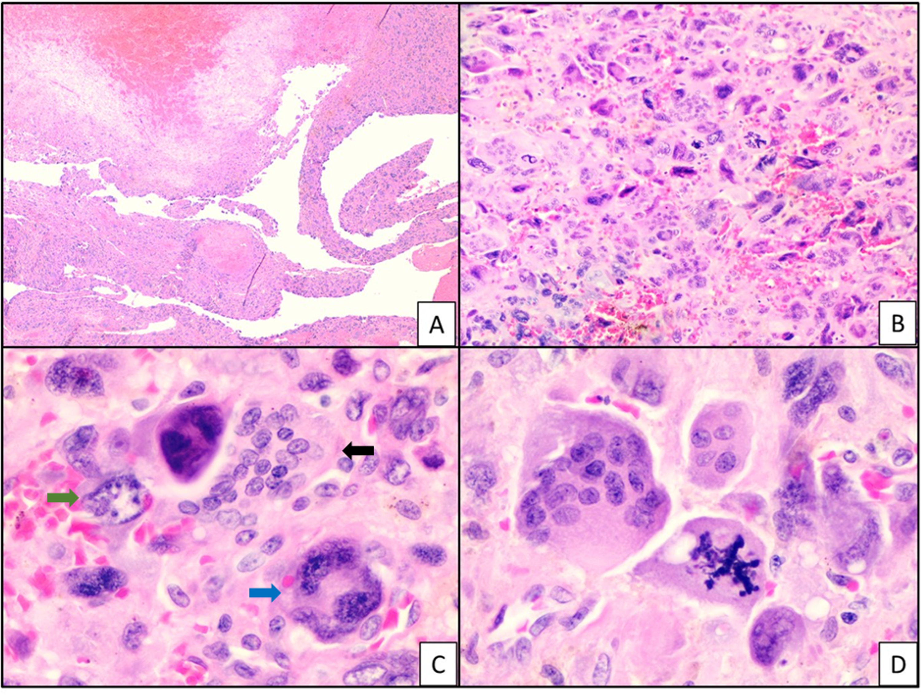 Cureus Undifferentiated Pancreatic Carcinoma With Osteoclast Like Giant Cells And Associated Ductal Adenocarcinoma With Focal Signet Ring Features