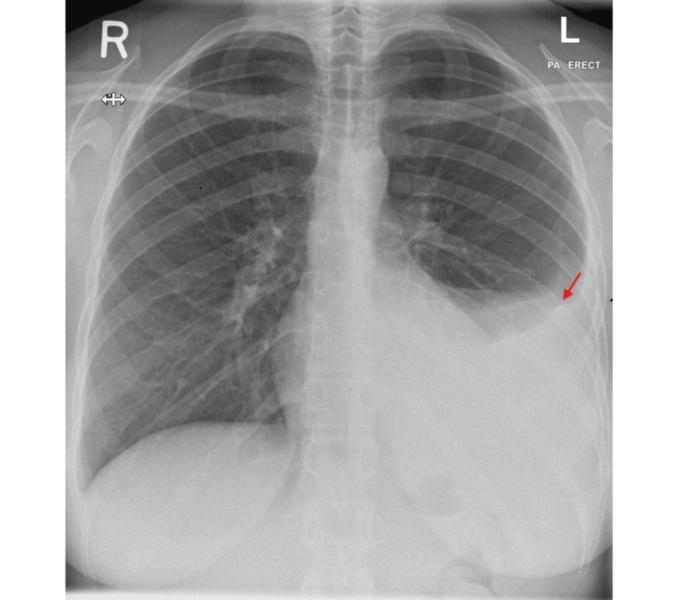 Photo: Cureus Pseudo-Pseudo Meigs Syndrome Diagnosed in Lupus Patient With Effusion