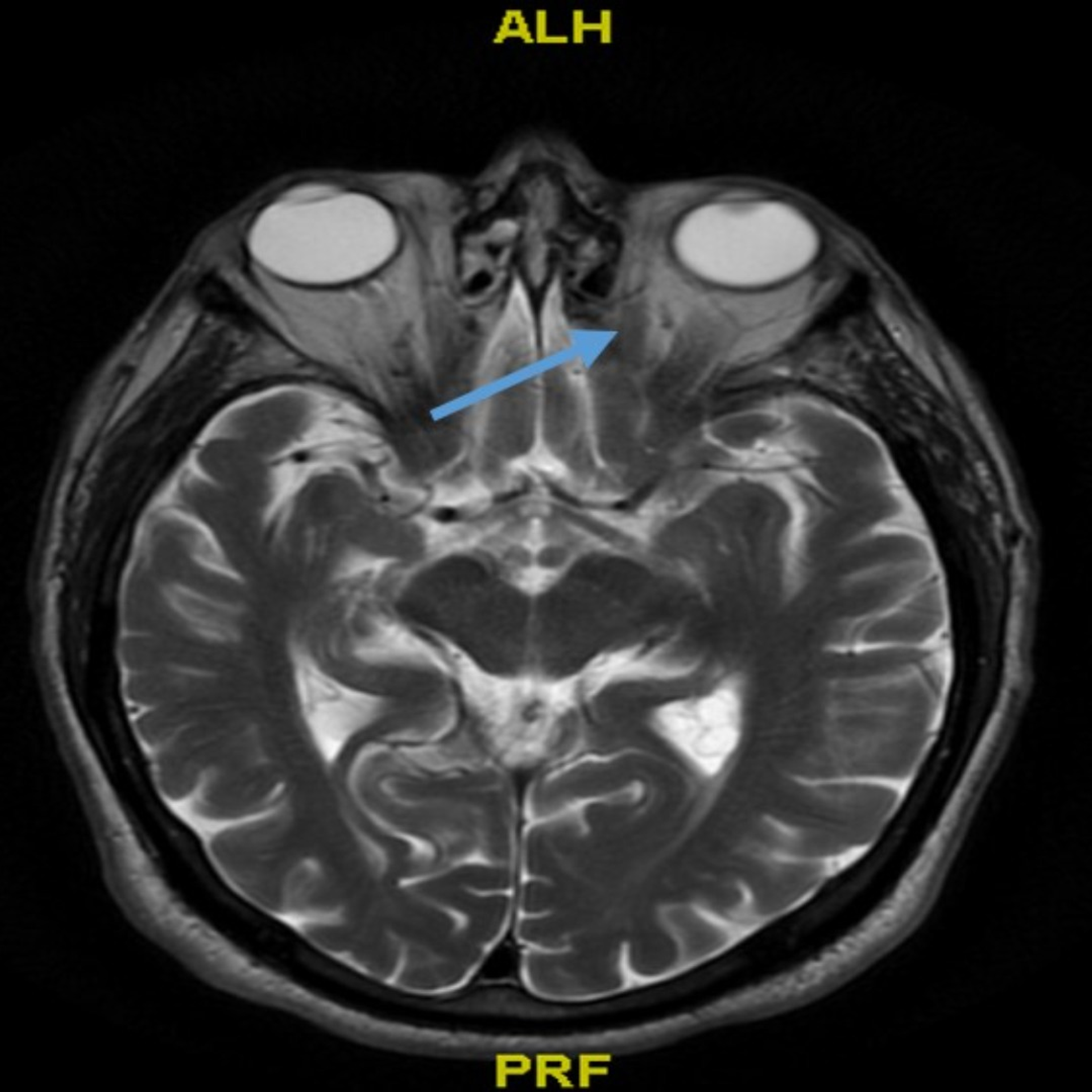 Cureus | A Rare Case of Statin-Induced Diplopia: An Often-Overlooked ...