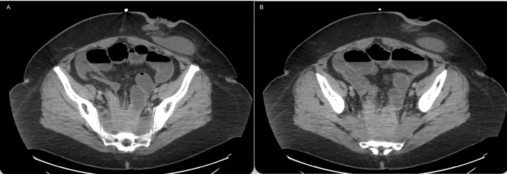 Incidental Appendiceal Adenocarcinoma Discovered After Ileocecectomy for Recurrent Small Bowel Obstruction: A Case Report