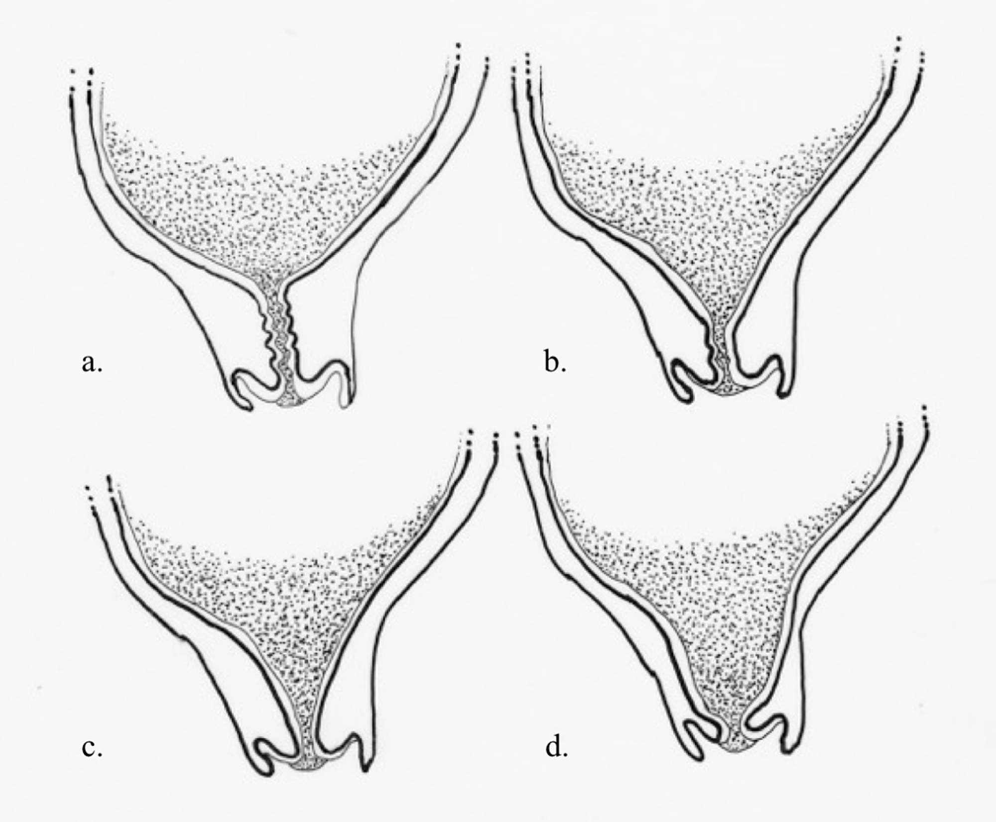 Cureus Cervical Funneling Potential Pitfall Of Point Of Care Pelvic Ultrasound