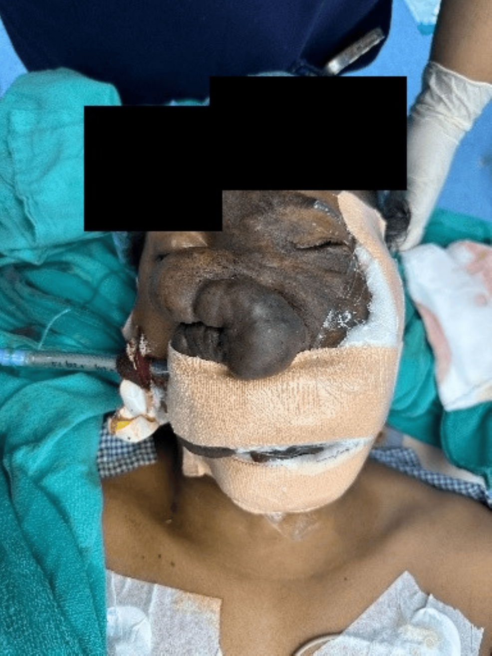 Successful-oral-endotracheal-intubation-following-fibreoptic-guided-airway-management-in-a-patient-with-a-giant-facial-plexiform-neurofibroma.