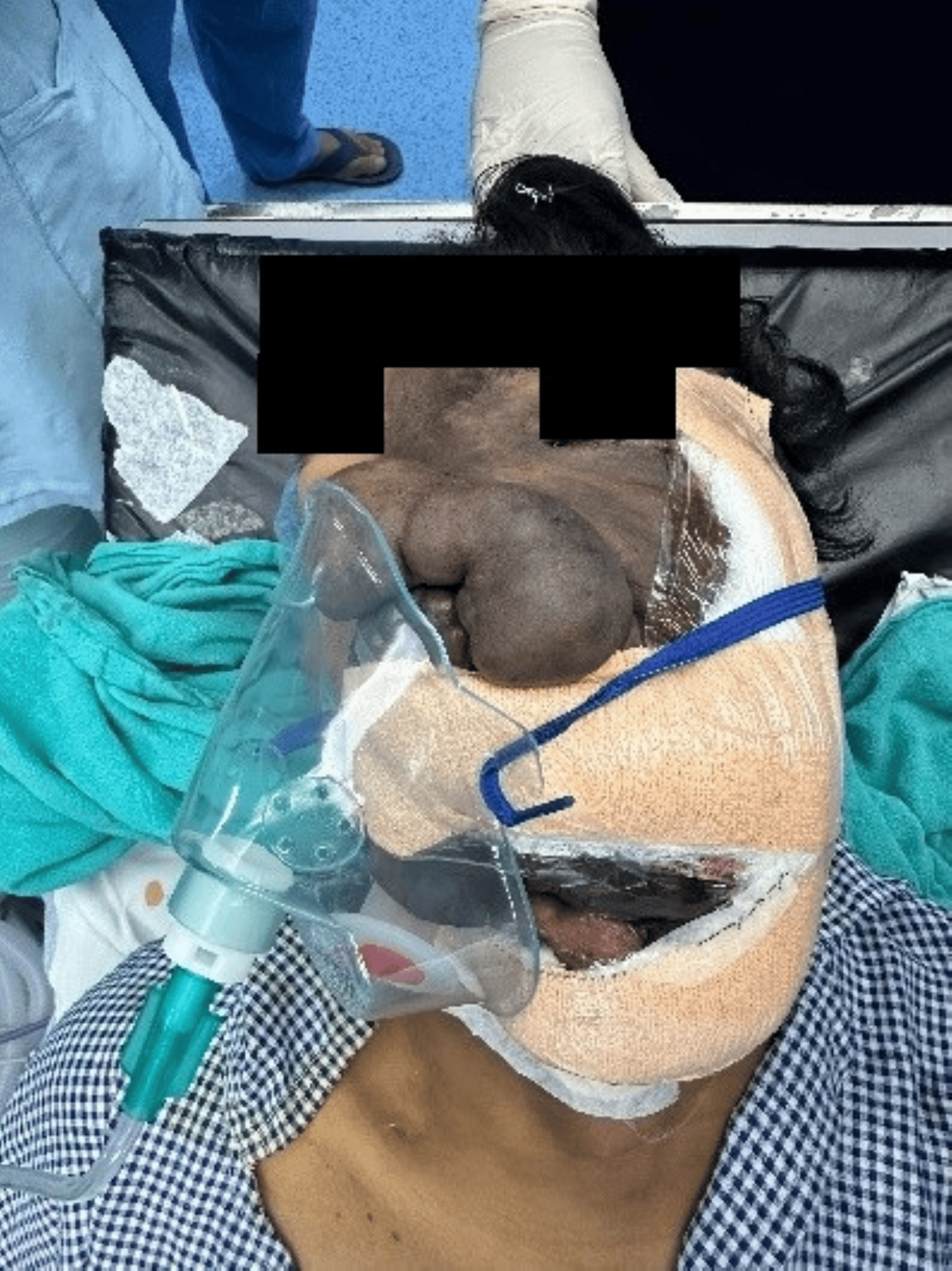 Immediate-postoperative-clinical-photograph-following-staged-debulking-of-the-giant-left-sided-facial-plexiform-neurofibroma,-demonstrating-reduced-tumour-bulk-and-successful-extubation-with-supplemental-oxygen-administered-via-face-mask.