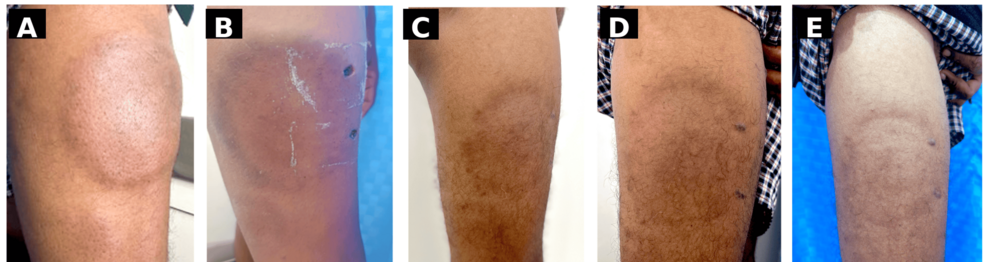 Subcutaneous Zygomycosis Treated with Itraconazole: Case Report