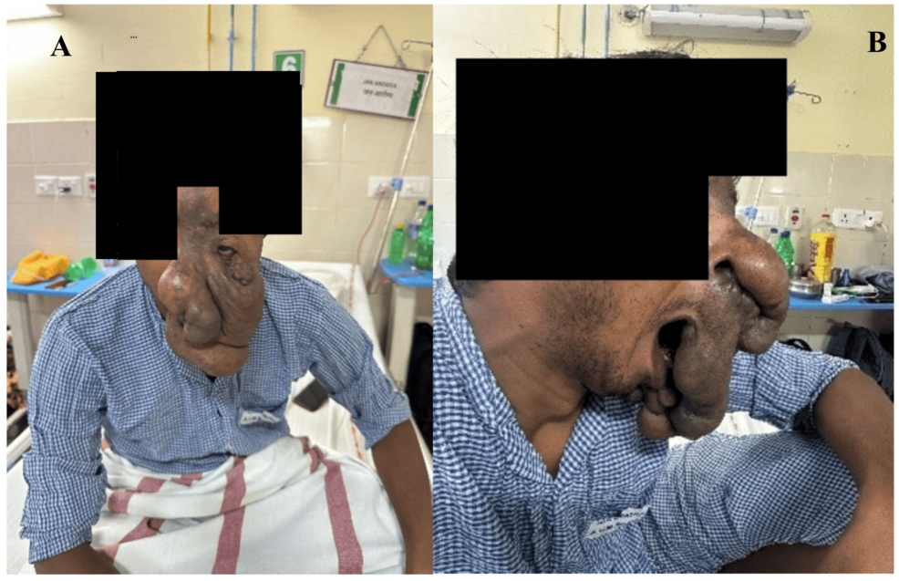 Preoperative-clinical-photographs-of-a-giant-left-sided-facial-plexiform-neurofibroma.-(A)-Frontal-view-demonstrating-the-extensive-involvement-of-the-glabella,-upper-eyelid,-nose,-cheek,-lips,-and-chin-with-marked-facial-asymmetry.-(B)-Left-lateral-view-showing-the-extent-of-the-tumour-involving-the-nose,-upper-lip,-cheek,-and-chin.