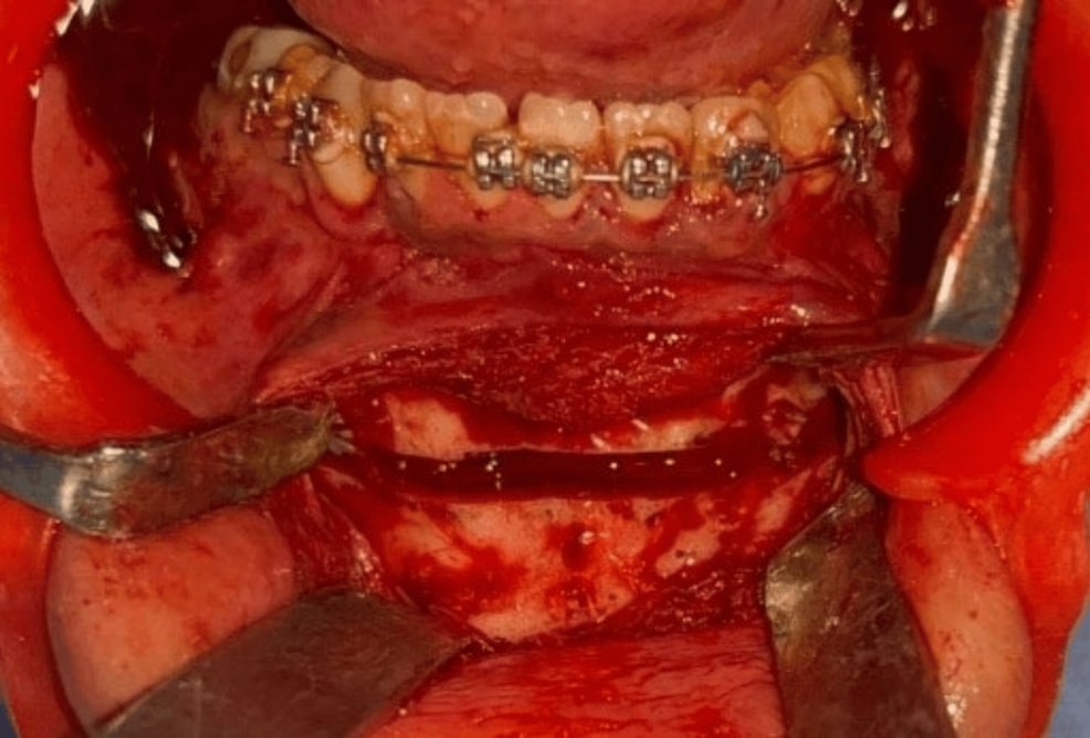 Genioplasty-osteotomy-site