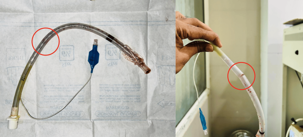 Partially-transected-endotracheal-tube-(marked-within-a-red-circle)