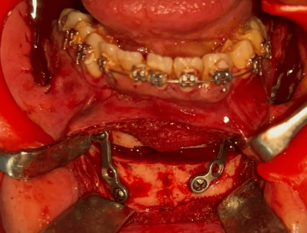 Fixation-of-the-genioplasty-segment