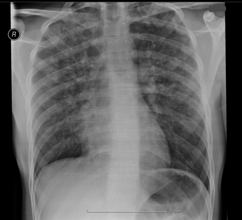 Initial-portable-post-operative-chest-radiograph