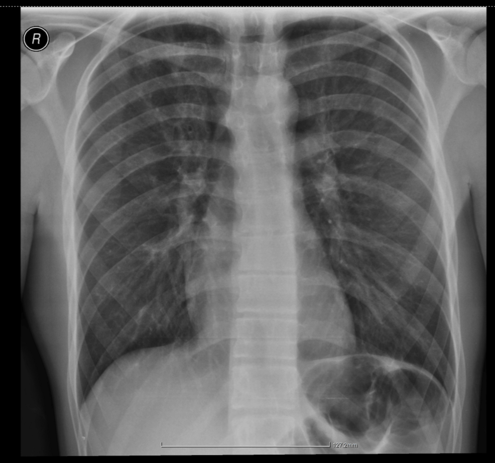 Follow-up-chest-radiograph