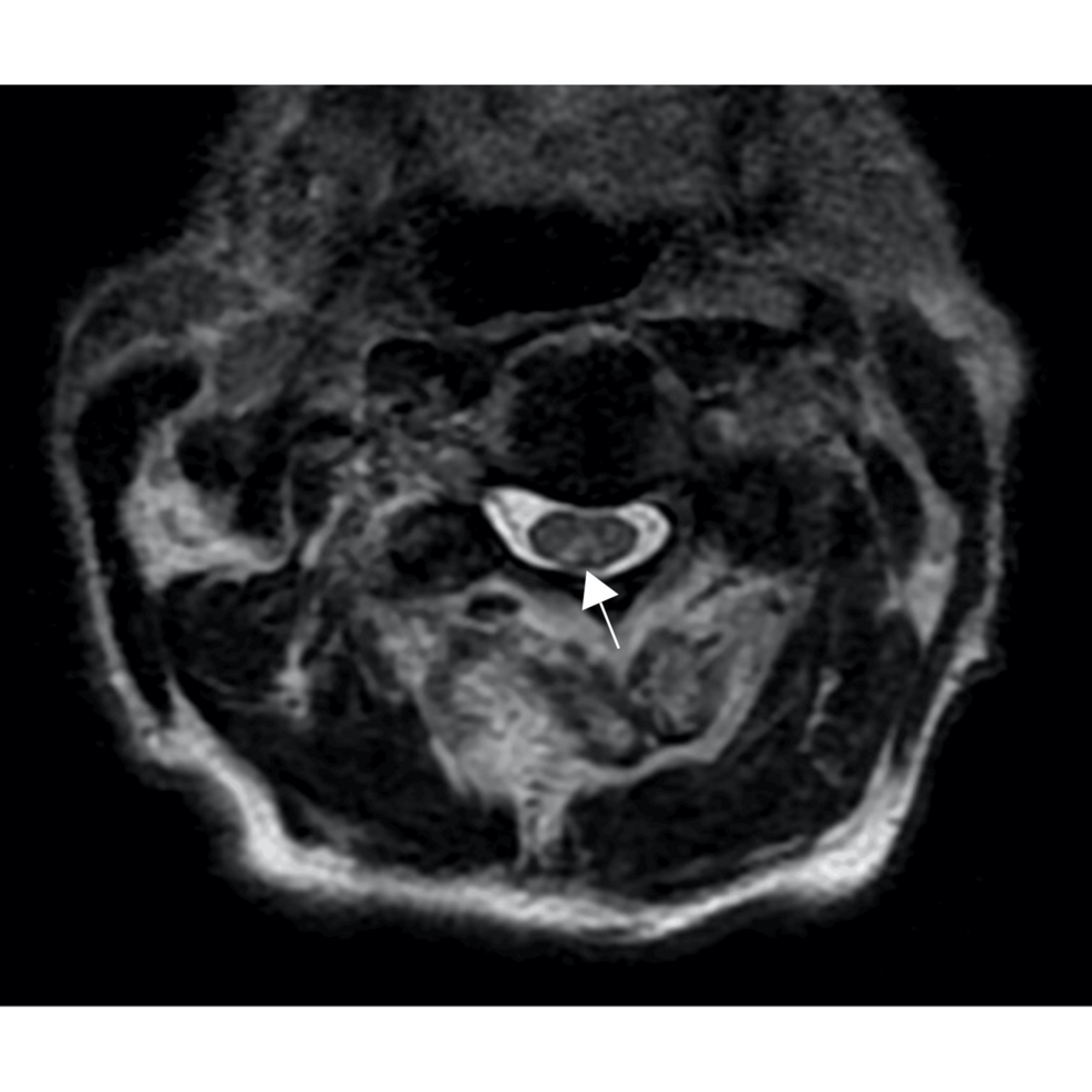 Subacute Combined Degeneration Mimicking Acute Traumatic Spinal Cord Injury