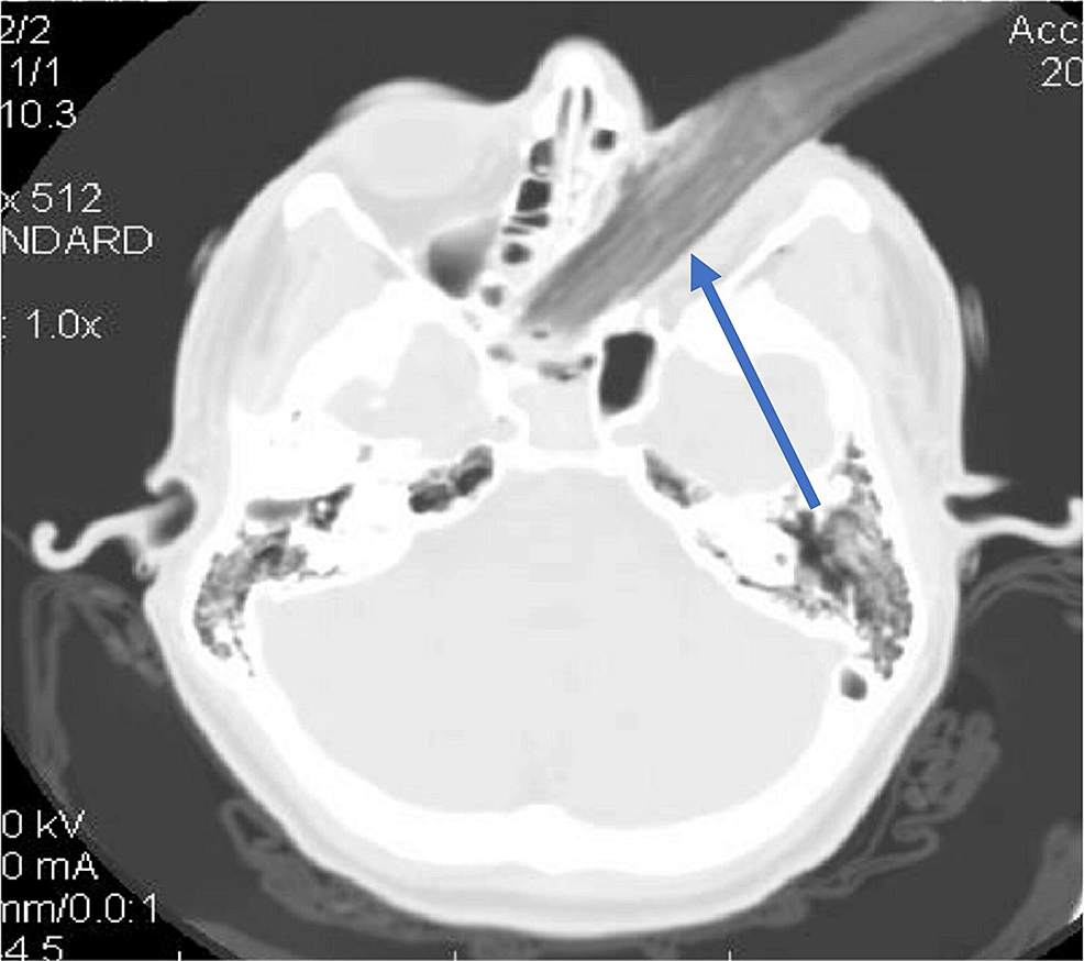 cureus-orbital-blowout-fracture-with-complete-dislocation-of-the