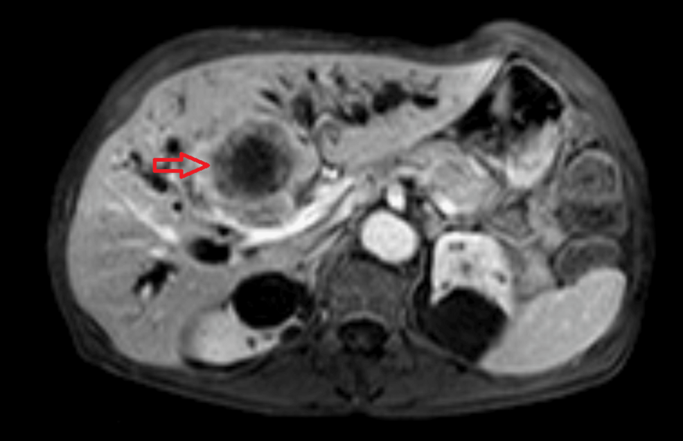 iv glutathione following ct scan Imaging Before and After Treatment with Endocrine Therapy. CT Severe Hypovolemic Hyponatremia Following Percutaneous