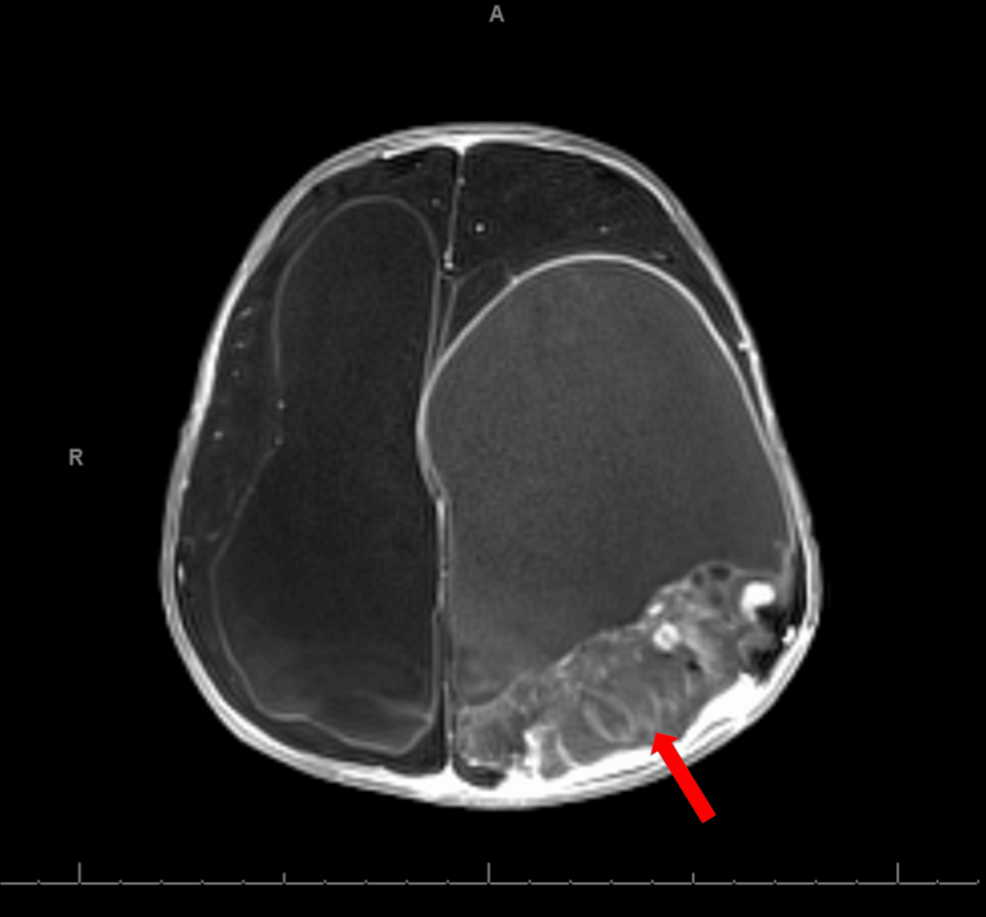 Larotrectinib Efficacy in Infant-Type Hemispheric Glioma with NTRK Fusion - News Directory 3