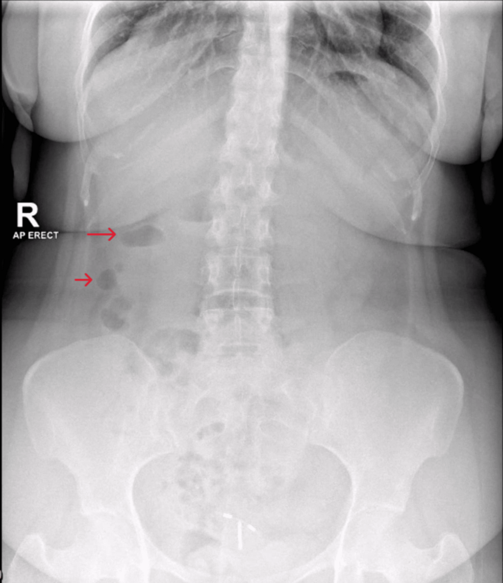 When Weight Loss Turns Dangerous: A Case Report of Tirzepatide-Induced Ketoacidosis in a Non-diabetic Woman