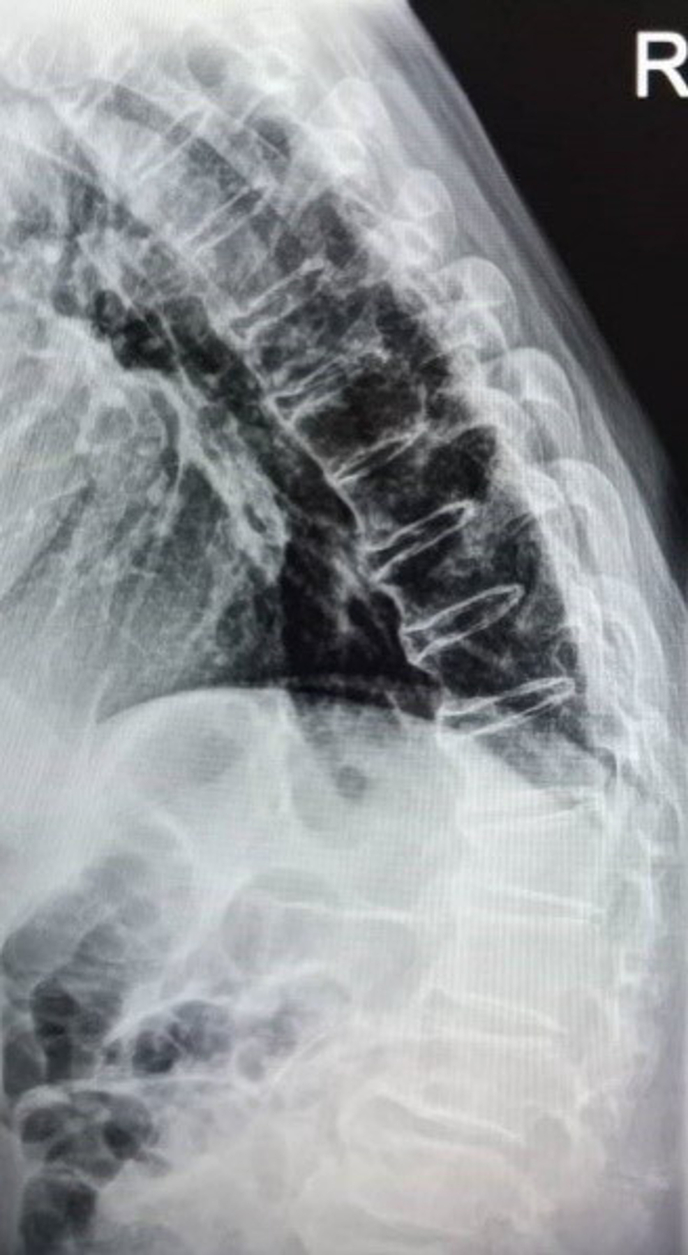 Cureus, Thoracolumbar Fracture in Disseminated Idiopathic Skeletal  Hyperostosis