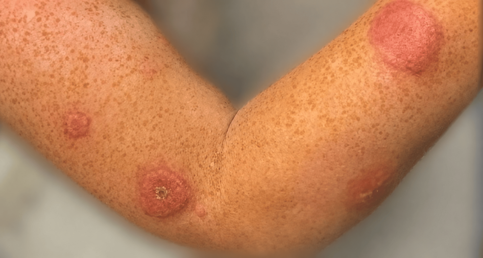 Interstitial Granulomatous Dermatitis Associated With Ulcerative Colitis: A Rare Cutaneous Manifestation