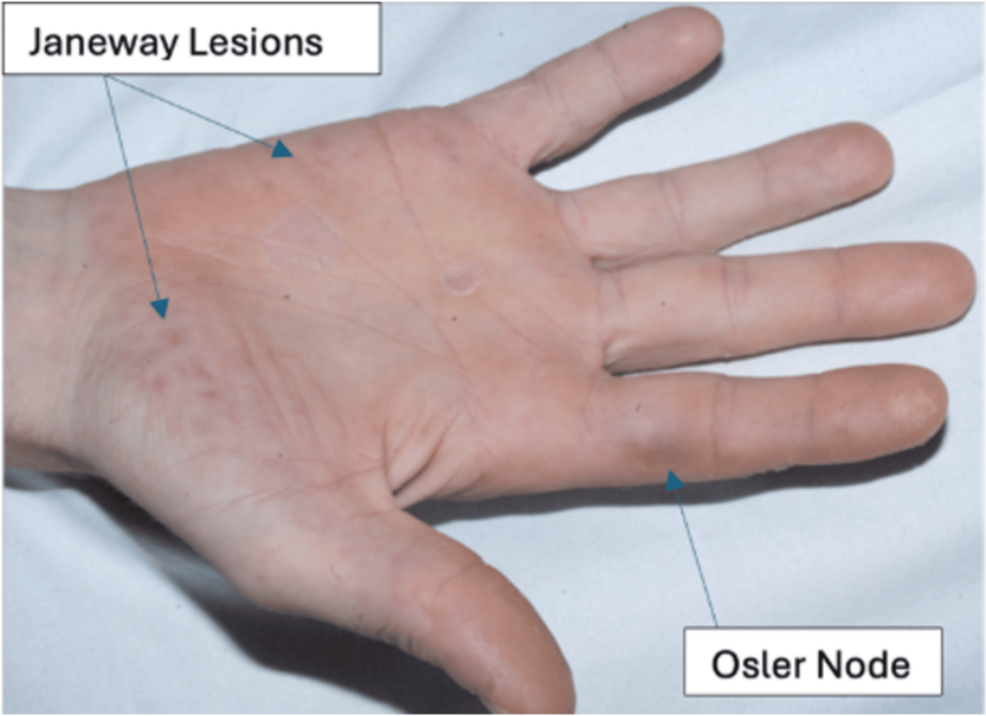 Native Aortic and Mitral Valve Endocarditis Caused by Nontoxigenic Corynebacterium diphtheriae in a Young Male Patient: A Case Report