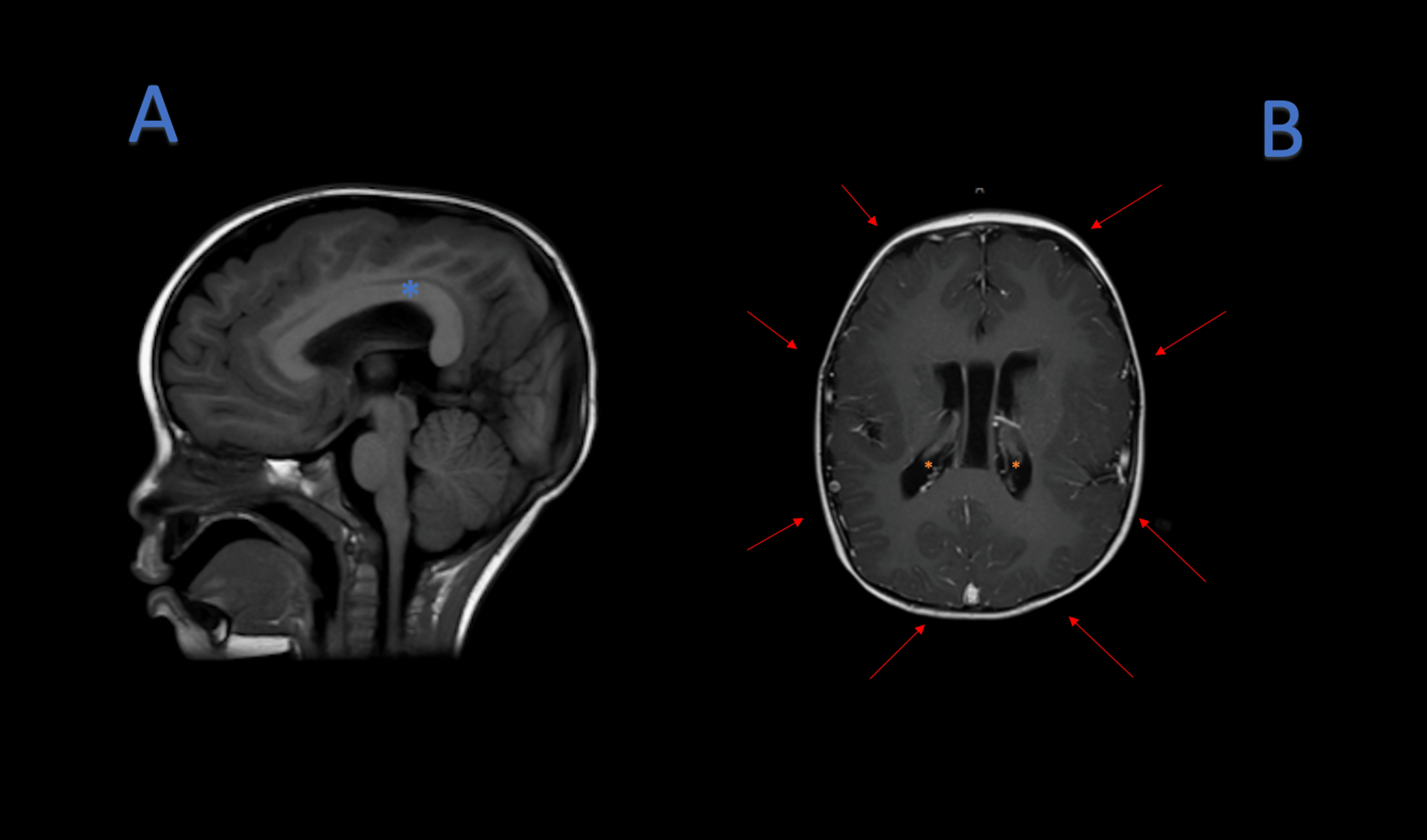 Cureus Megalencephaly Polymicrogyria Polydactyly Hydrocephalus Mpph A Case Report And Review Of Literature