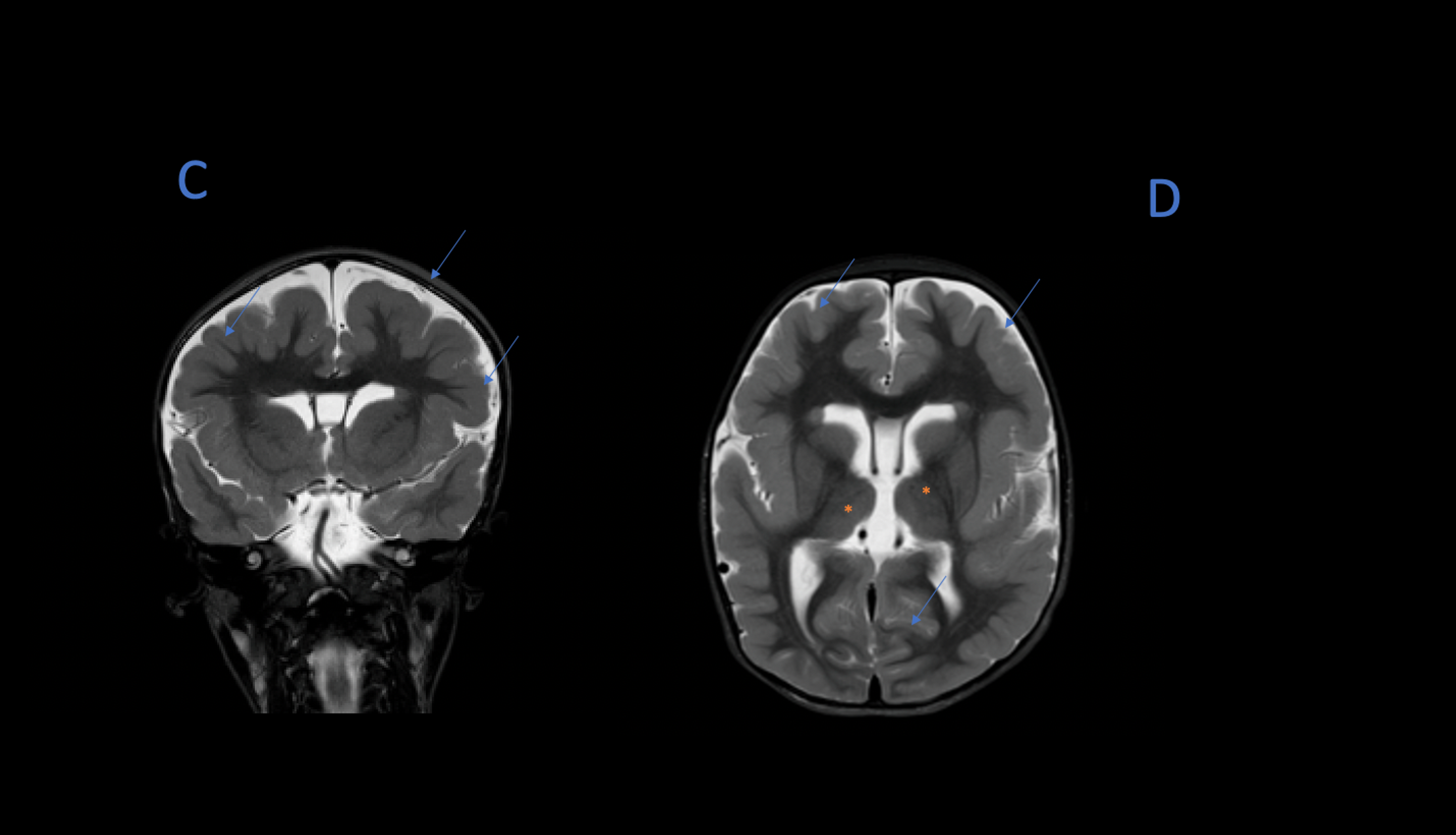 Cureus Megalencephaly Polymicrogyria Polydactyly Hydrocephalus Mpph A Case Report And Review Of Literature