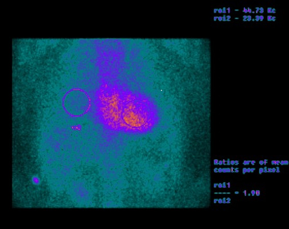 Nuclear-imaging-of-99mTc-PYP-planar-scintigraphy-showing-significant-uptake-of-cardiac-99m-Tc-PYP-in-the-myocardium-compared-to-the-ribs.-Circular-target-ROI-are-drawn-over-the-heart-on-the-planar-images-as-well-over-the-contralateral-chest.-A-H/CL-ratio-is-calculated-as-the-fraction-of-heart-ROI-mean-counts-to-contralateral-chest-mean-counts.-H/CL-ratios-of-->1.5-are-classified-as-ATTR-positive-at-one-hour-post-injection.
