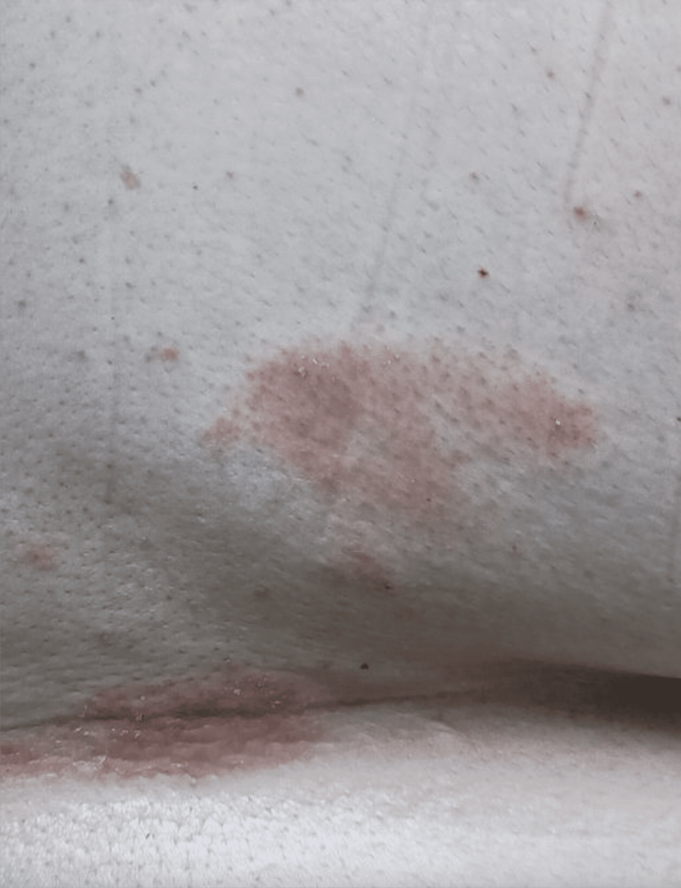 Psoriasiform Dermatitis Following JAK Inhibitor Therapy for Hidradenitis Suppurativa and ...