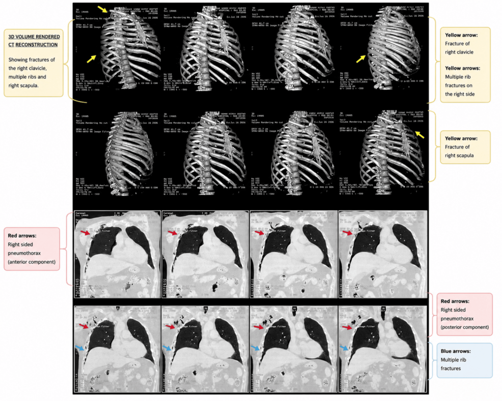 Preoperative-CT-of-the-thorax-demonstrating-the-traumatic-injuries