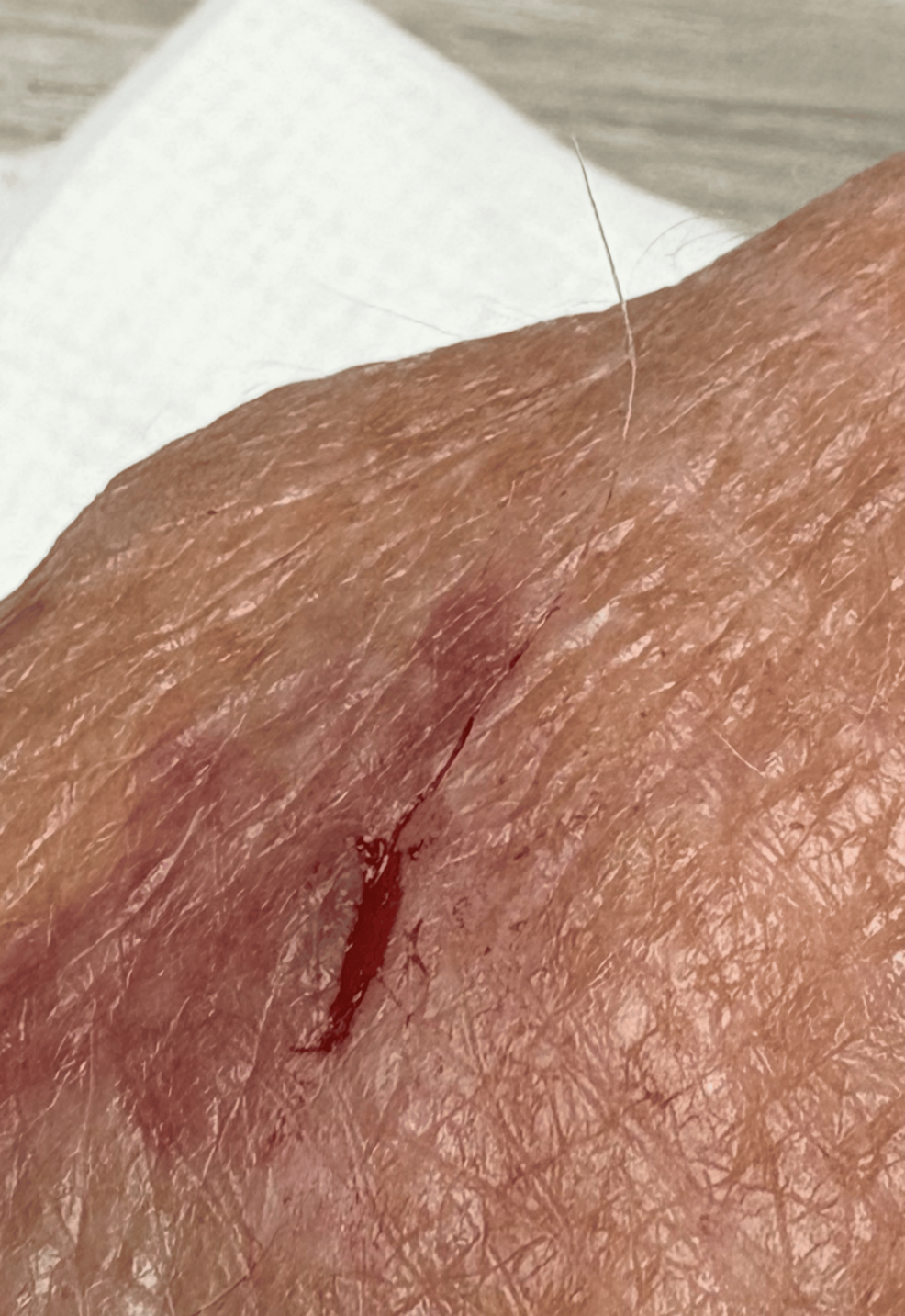 Cat Anatomist: Exteriorization of a Presumed Digital Nerve Fascicle Following a Cat Scratch Injury