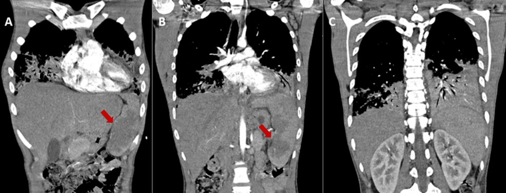 VV-ECMO May Bridge Recovery for Patients With Hematologic Malignancies