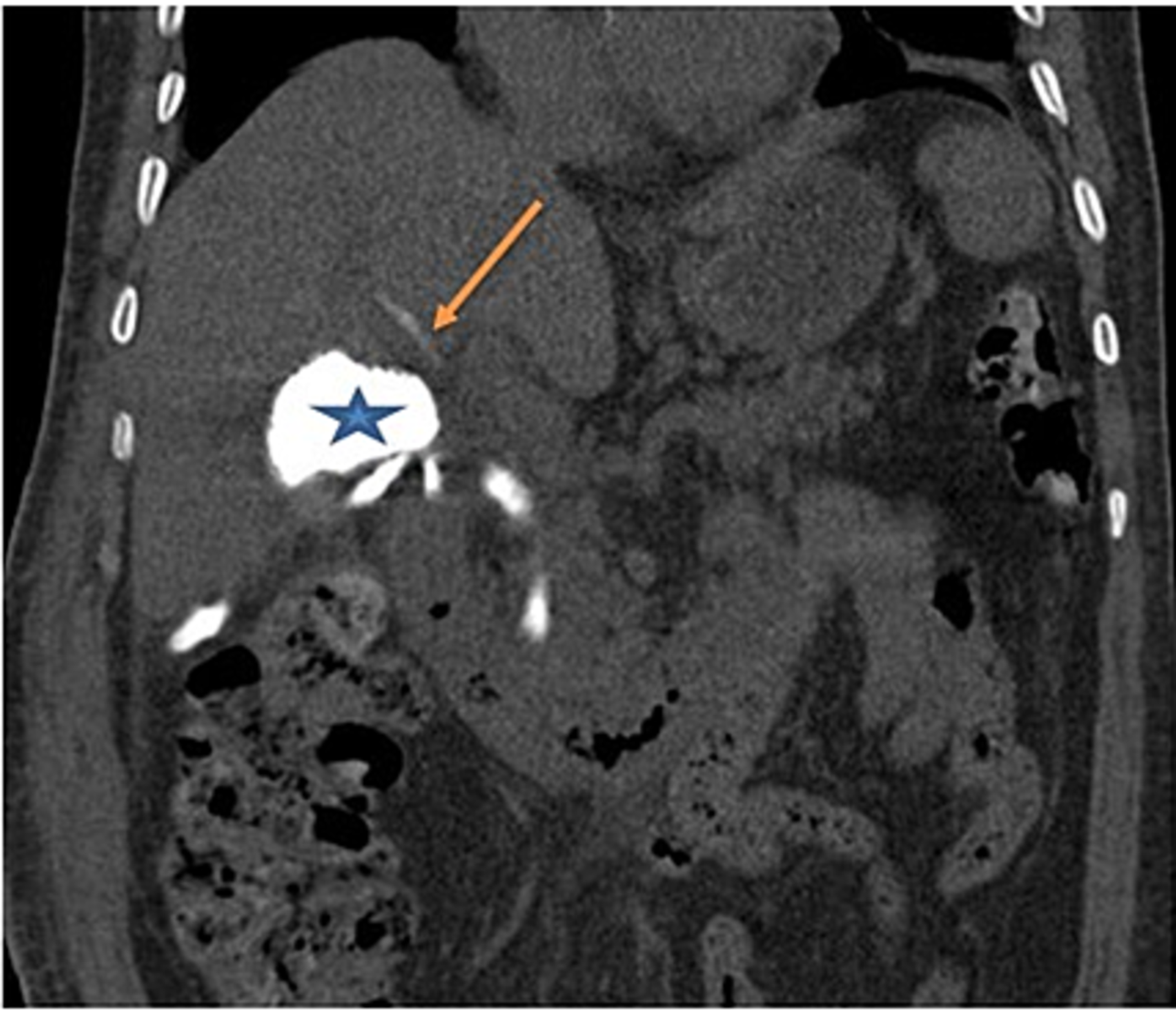 Cureus The Duct Of Luschka An Anatomical Variant Of The Biliary Tree Two Case Reports And A 1137