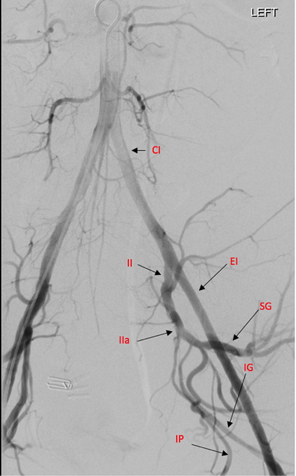 Cureus | Large Retroperitoneal Hematoma: A Rare Intraoperative ...