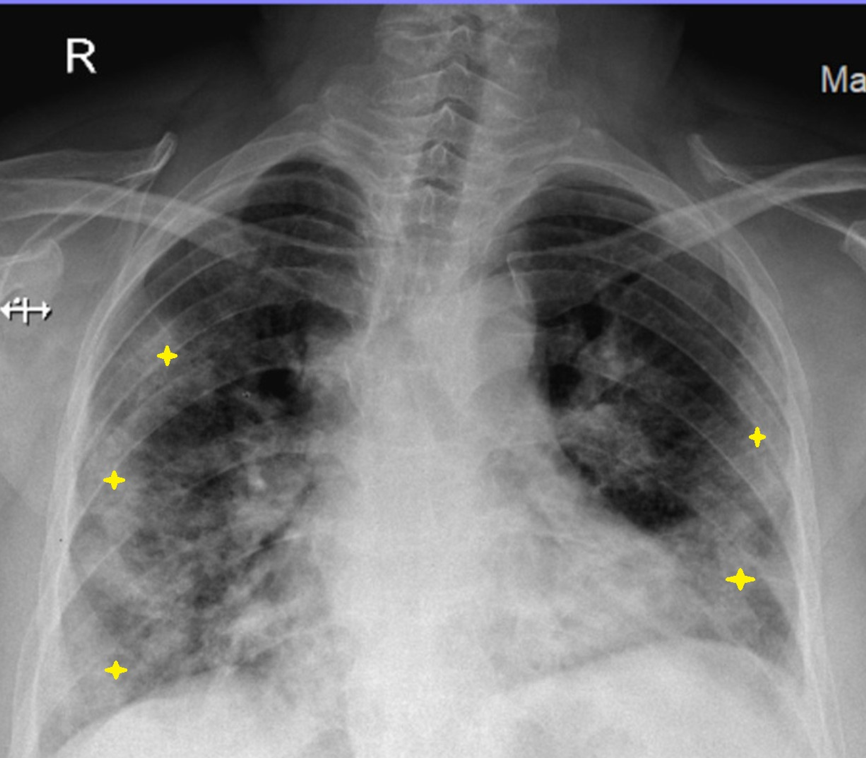 staph pneumonia chest x ray findings